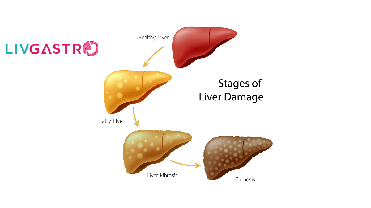 Fatty Liver Disease: Forms, Symptoms, Diagnosis & Treatment