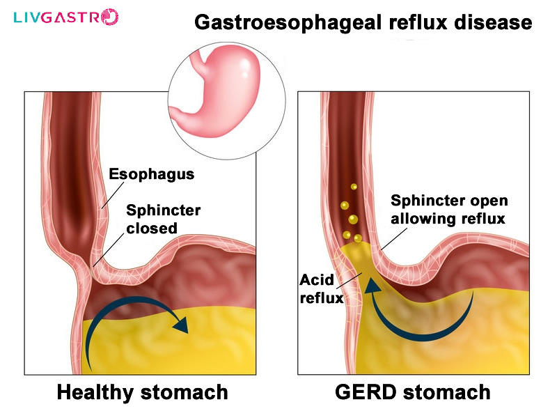 Gastroesophageal Reflux Disease: Causes, Risk Factors, Symptoms & Complications