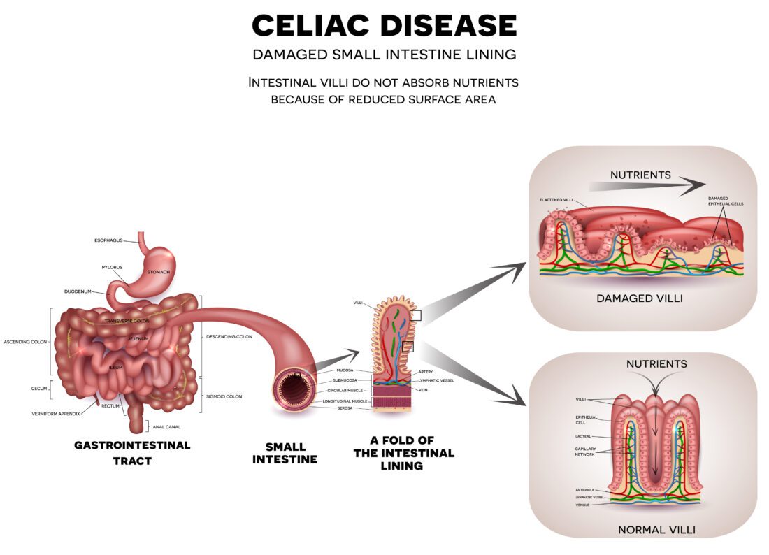 Celiac disease: Cause, Symptoms, Diagnosis and Treatment