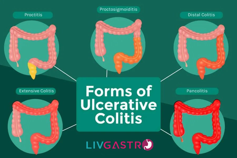 Ultimate Guide to Colitis: Types, Causes, Symptoms & Treatment