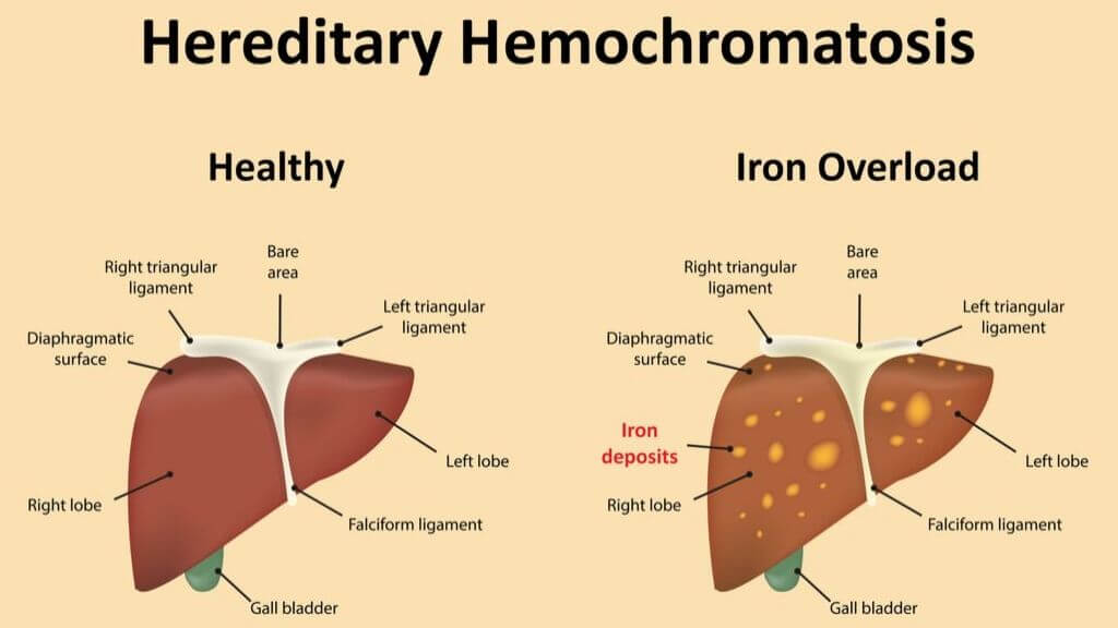 Are YOU a Victim of Hemochromatosis?