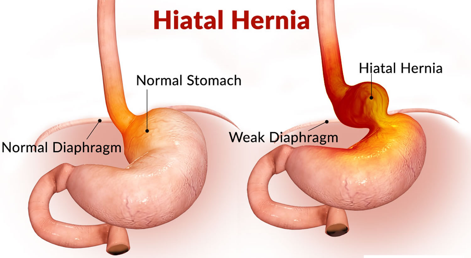 Hiatal Hernia: Understanding its Symptoms, Diagnosis & Treatment
