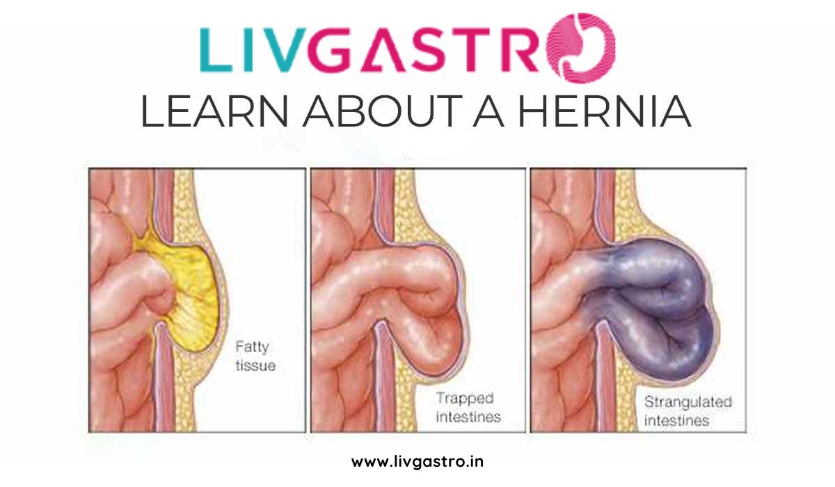 Hernia Treatment in Kolkata: Insights into the Various Types and Remedies