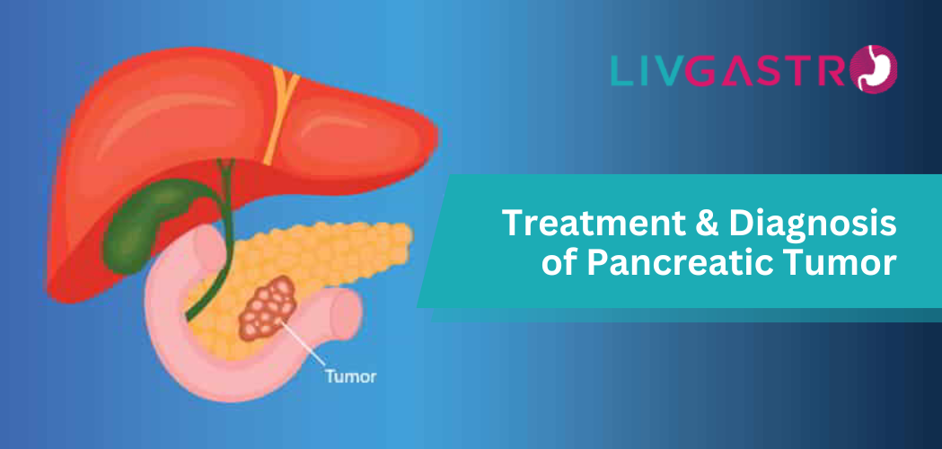 Pancreatic Tumors: Types, Diagnoses And Treatments