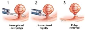Endoscopic Mucosal Resection by Livgastro