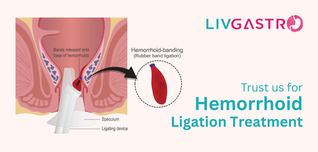 Best Gastroenterology Hospital in Kolkata for Hemorrhoid Ligation