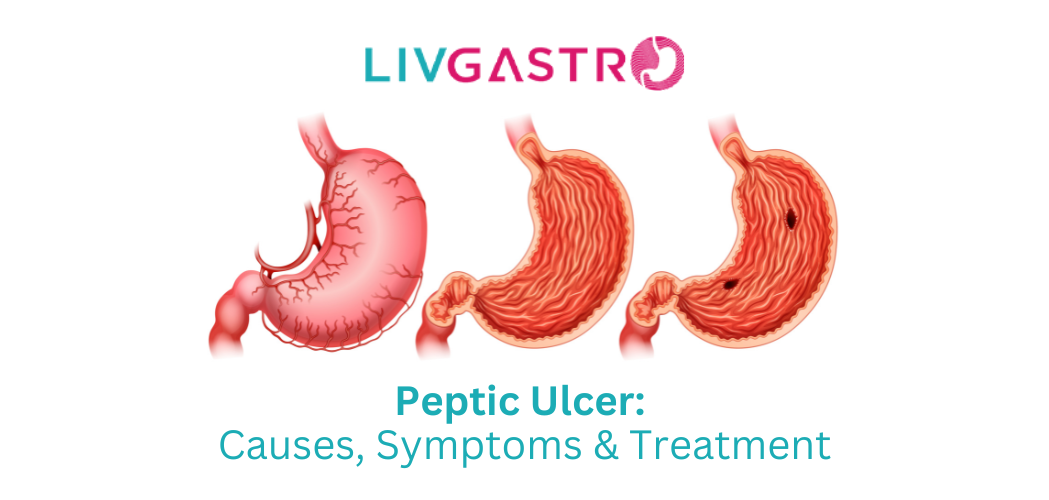 When Stomach Pain Becomes Serious: Signs You Need a Gastroenterology Specialist for a Peptic Ulcer