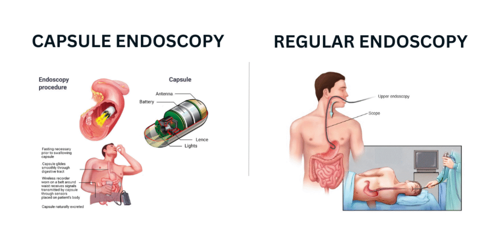 Capsule Endoscopy Different from a Regular Endoscopy