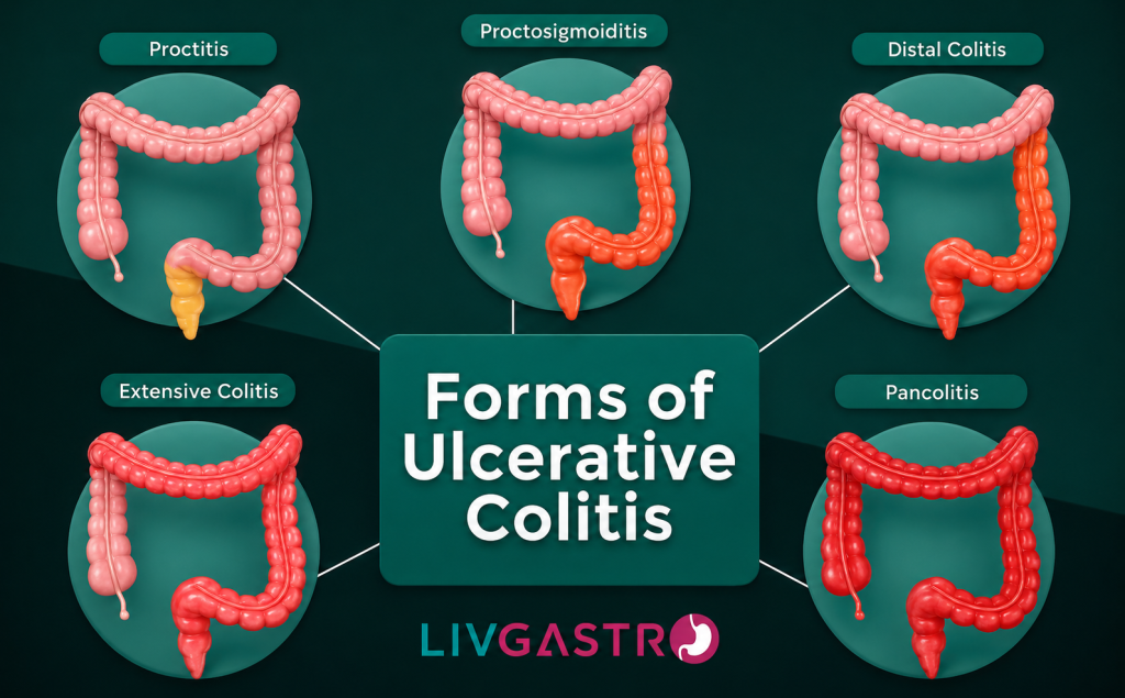 Medical illustration showing inflammation of the colon associated with colitis and its symptoms.