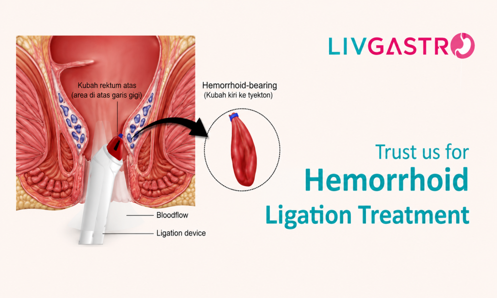 Doctor consulting a patient about hemorrhoid ligation treatment at a leading gastroenterology hospital in Kolkata